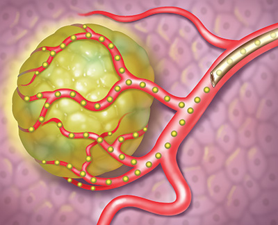 Cra Imaging Tumor Microspheres